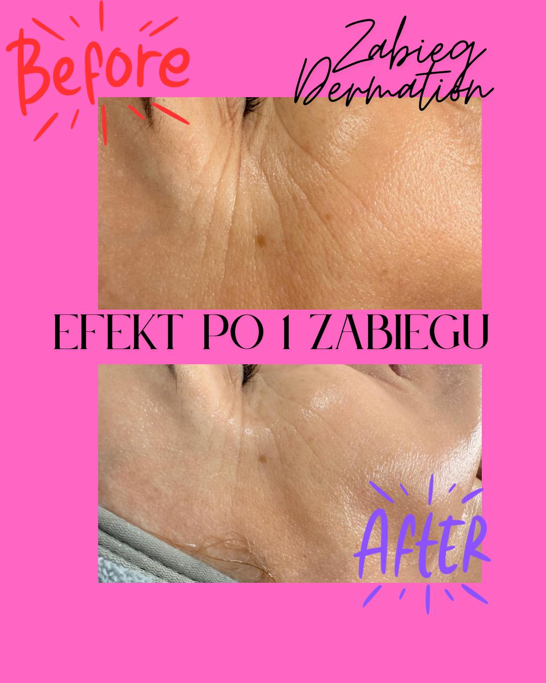 Efekt zabiegu 8